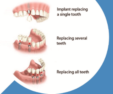 implant teeth-9-583-858